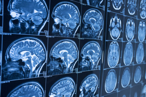 Types of Traumatic Brain Injuries