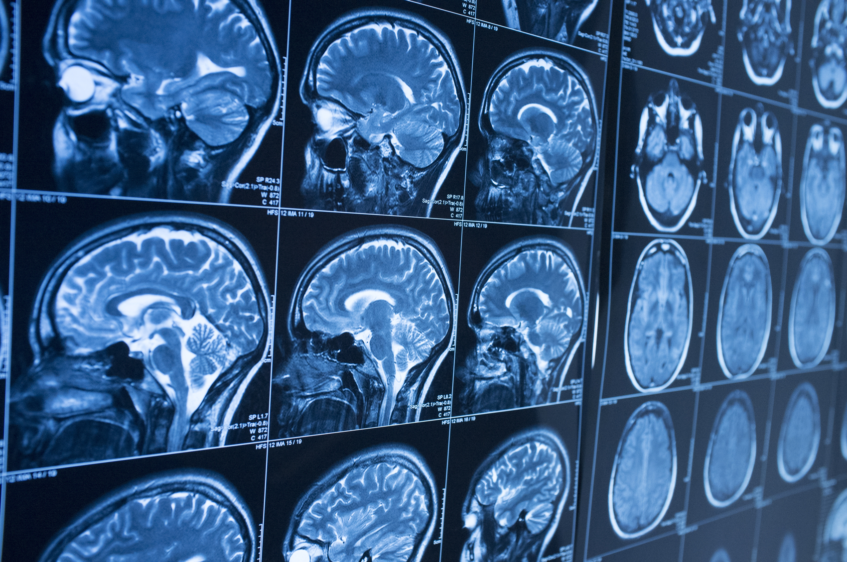 Depo-Provera Brain Tumor Lawsuit